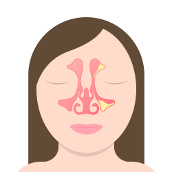 Recurrent Sinus Infections
